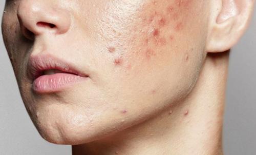 Какие методы лечения акне предлагает врач-дерматолог Юлиана Шиян Какие методы лечения акне предлагает врач-дерматолог Юлиана Шиян