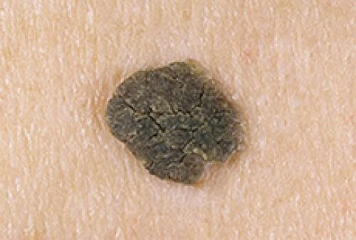 Как убрать возрастные пигментные пятна. Пигментные пятна на лице: причины появления 01